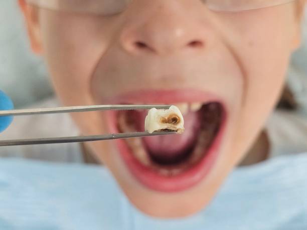 Best Emergency Root Canal Treatment in Fairmount, TN